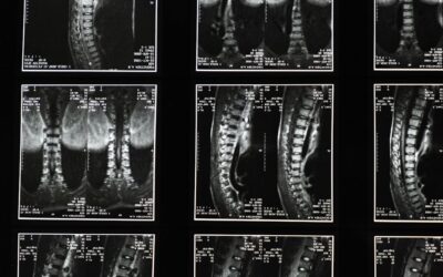 Sciatica vs. Herniated Disc – differences, symptoms and chiropractic treatments
