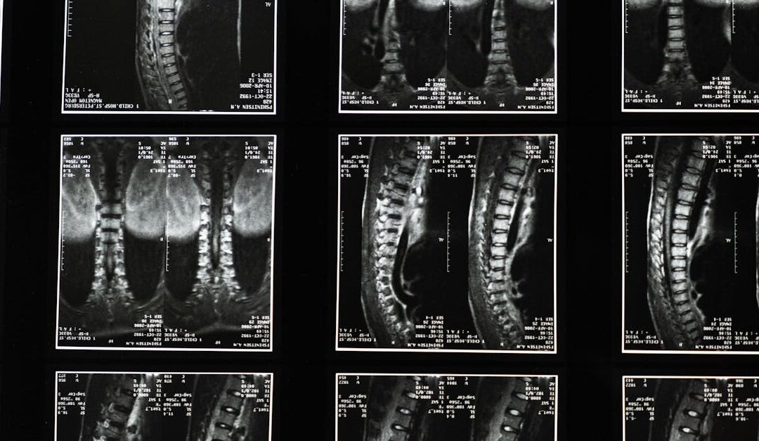 Spinal Degeneration: stages, risk factors and chiropractic management